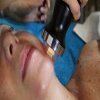 Microneedling3-700x420x72dpi