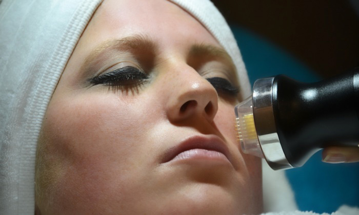 Microneedling1-700x420x72dpi